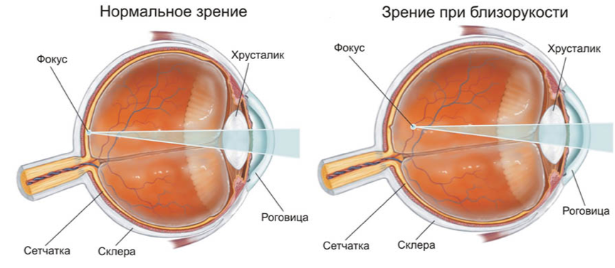 Близорукость